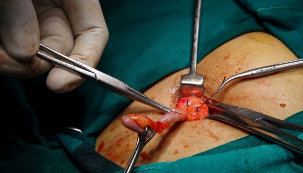 Appendix (अपेंडिक्स) का Treatment (उपचार)-